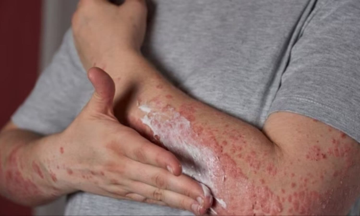 Advances in Understanding Cutaneous Lupus ...