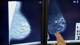 Why are Oklahoma women getting huge bills for a breast scan that should be 100% covered?