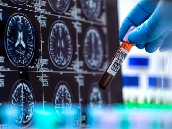 As amyloid falls out of favor, here’s where Alzheimer’s R&D is headed next