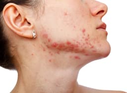 Beyond Isotretinoin: New Review Explores the Evolving Landscape of Systemic Acne Therapy | Dermatology Times