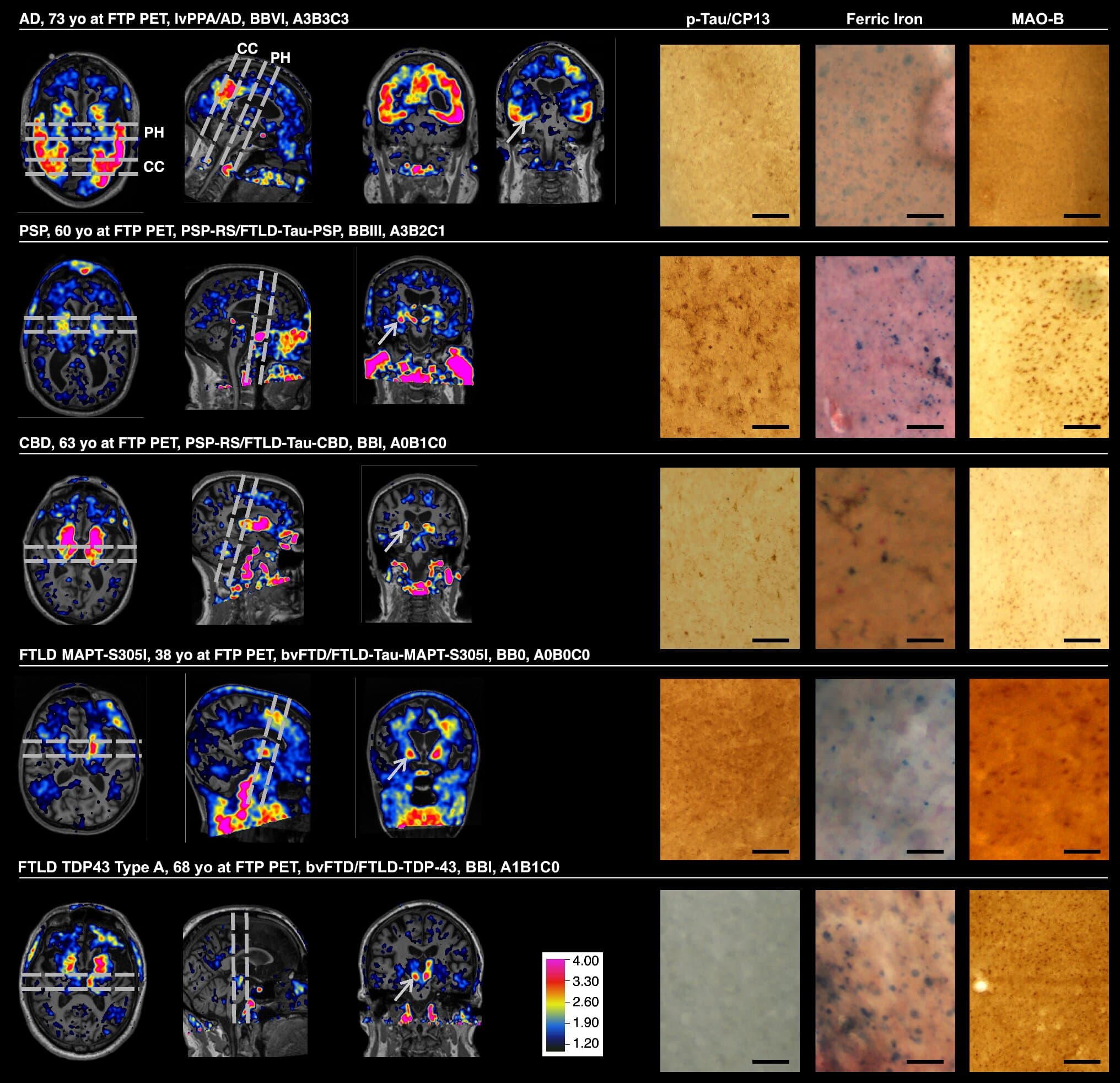 Are tau PET scans 'lighting up' too much of the brain in Alzheimer's disease?