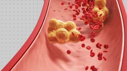 BBC News - Excitement Over Trial of Single-Dose Cholesterol Treatment