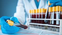 Blood Biomarkers May Track Early Alzheimer's Brain ...