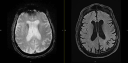 Donanemab Infusion and Recurrent Seizures in a Patient ...