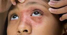 Contact Dermatitis