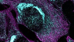 New Blood Test Could Identify Stage Of Alzheimer’s Disease Just As Accurately As Expensive Scans