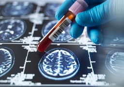 Blood circRNAs Can Predict Alzheimer's Years Prior to ...