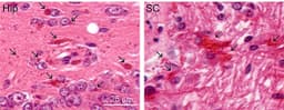 First drug to treat Alexander disease approved by the FDA after ...
