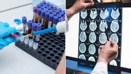 Blood test breakthrough could transform Alzheimer's fight, ...