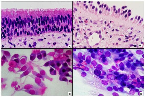 Nasal Cytology as a Cellular Window into Epithelial Dysfunction and Type 2 Inflammation: From Mechanisms to Translational Implications