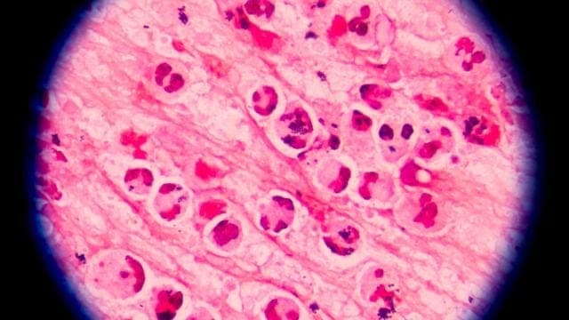 Where are we at with Cyclospora?