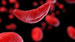 Gene editing therapy shows success against severe sickle cell disease