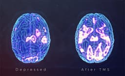The Networks Behind Mental Illness and How TMS Targets Them