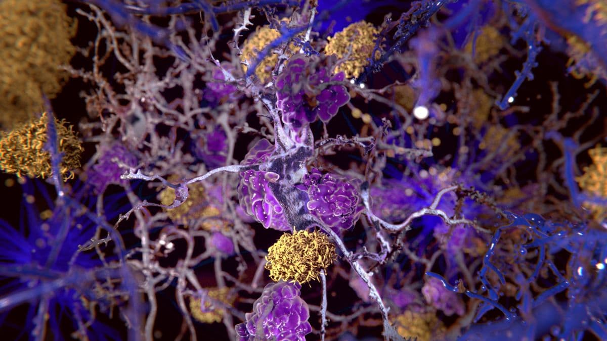 Alzheimer’s/PD/DLB biomarker and treatment momentum