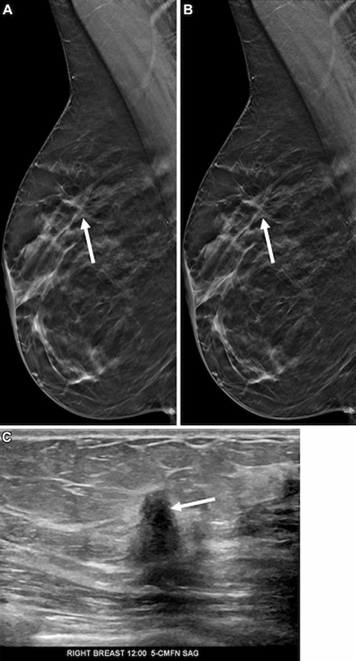 GE HealthCare-RadNet AI Mammography Expansion and AI Workflow Advances