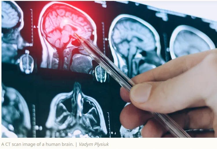 Alzheimer’s Blood Tests Have a Blind Spot. Scientists May Have Found a Fix