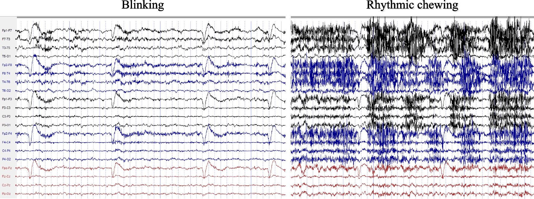 Automatic EEG artifact detection using a local-global feature fusion network in time and time-frequency domains | Acta Epileptologica | Springer Nature Link