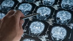 One-Size-Fits-All Dementia Prevention Doesn't Work