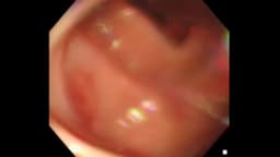 @CMHungSteven reposted: Releasing Colon-Bench

A colonoscopy video understanding benchmark for MLLMs on ...