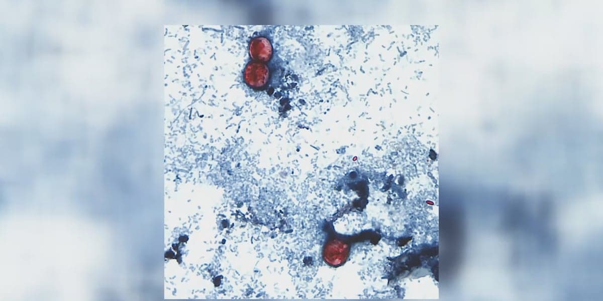 Cyclosporiasis Outbreak Reported in Lansing Area