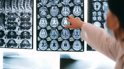 Only Two Drugs Can Slow Alzheimer’s & Both Work Best Caught Early
