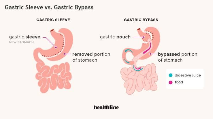 Top 10 Questions About Bariatric Surgery Answered!