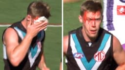 Port Adelaide star left in a bloody mess after nasty elbow ...