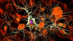 Alzheimer's Signs Hidden in Midlife Brains, Study Shows