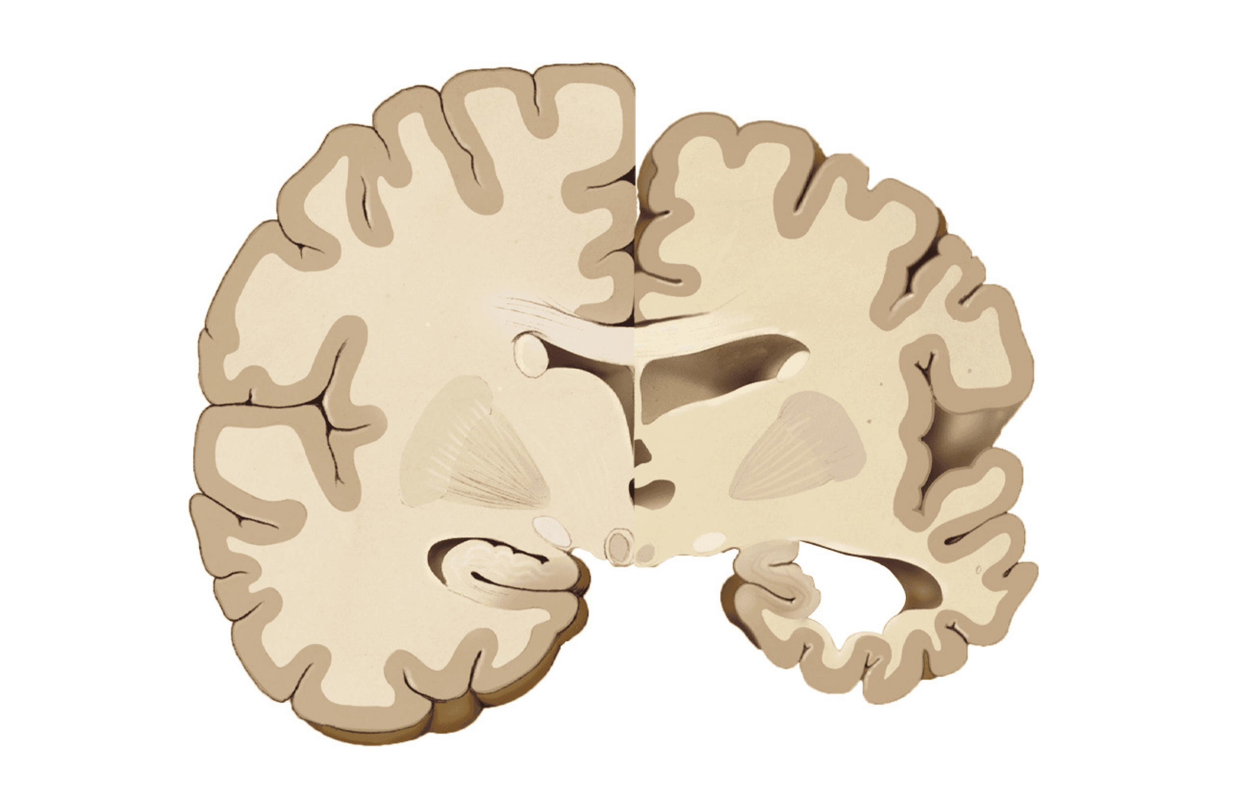 New Era in Alzheimer’s Disease Antibody Treatment - Mabion