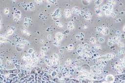 Rising Early-Onset Colorectal Cancer Concerns