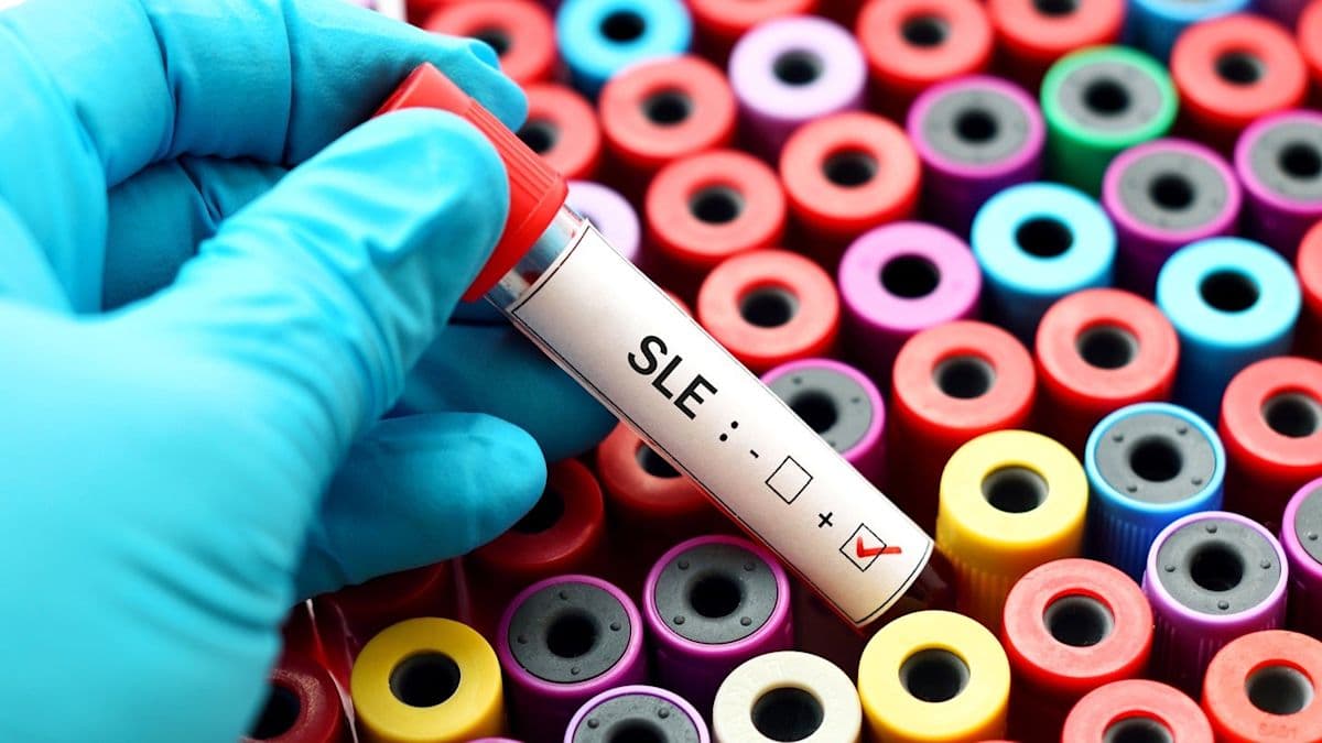 Beeline Medicines' Phase II SLE trial of afimetoran meets primary ...