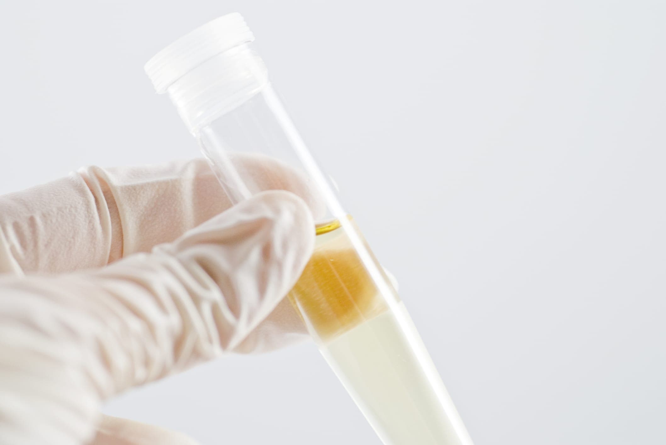 FDA Grants Breakthrough Designation to Urine-Based Alzheimer’s Test