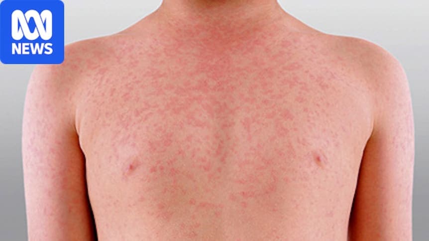 Warnings of possible measles outbreak as study finds 1.7 ...