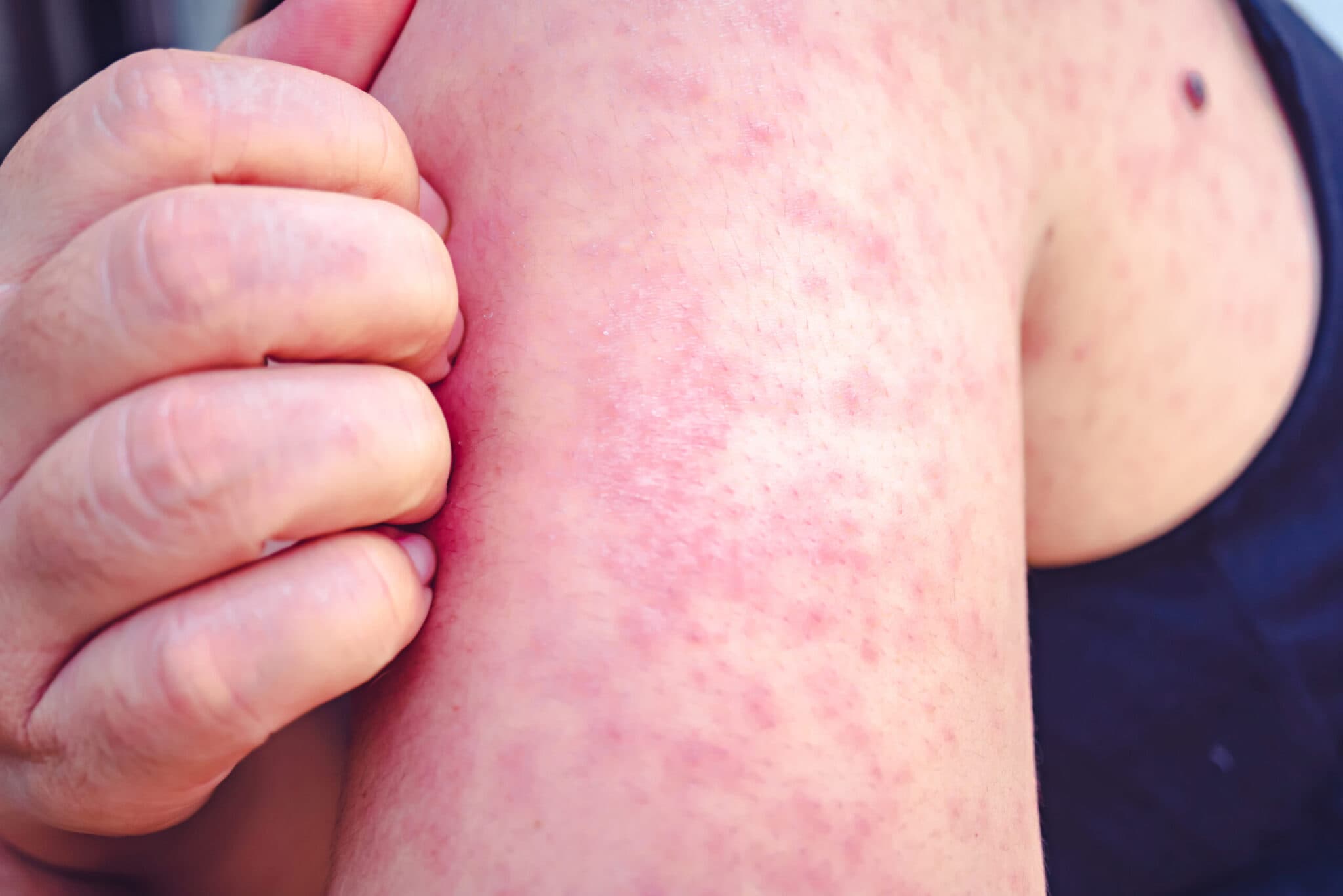 Measles multistate outbreak >4k cases; RFK Jr. congressional attack