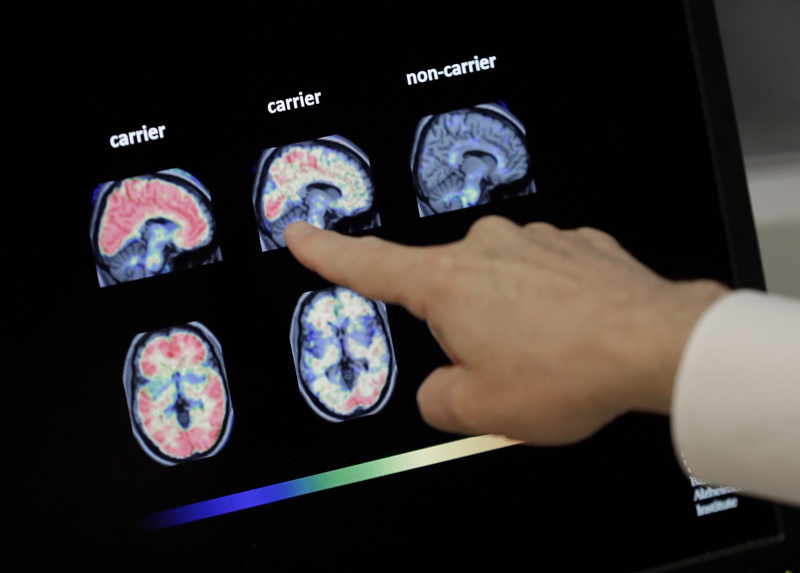 Researchers work to address Alzheimer’s and dementia in rural communities