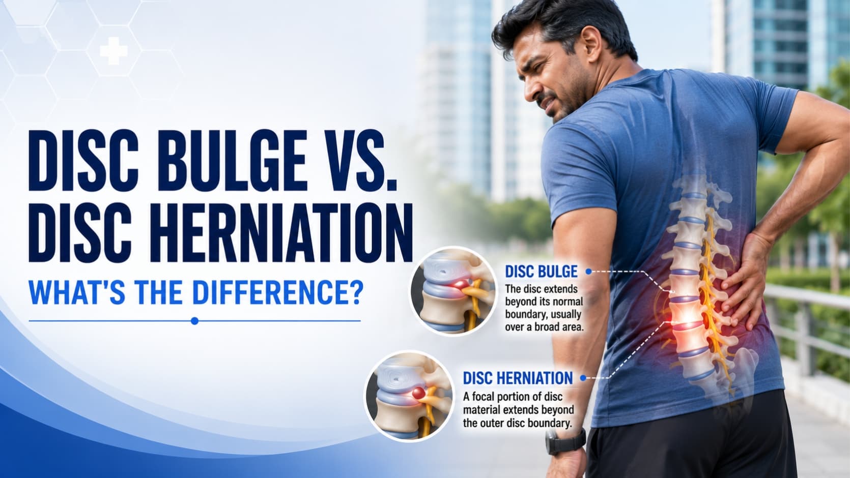 Disc Bulge vs Disc Herniation: Symptoms, Treatment & ...