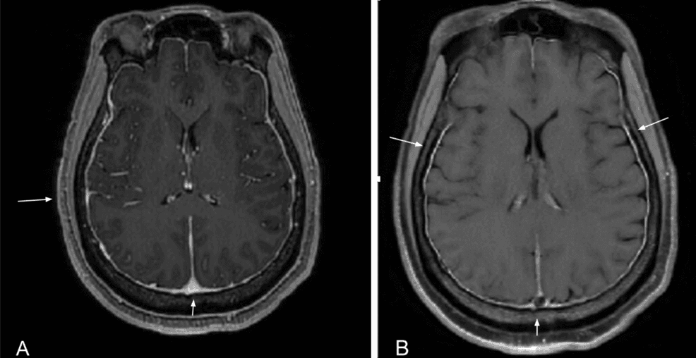 Psychosis and Pericardial Effusion in Neuropsychiatric Systemic ...