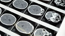 How does Alzheimer's kill off brain cells? UK researchers ...