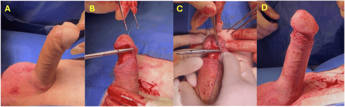 Glanspexy for real glans hypermobility after penile prosthesis surgery: a retrospective review and patient satisfaction analysis | International Journal of Impotence Research