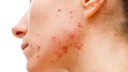 Antibiotic Tx of acne may be increasing resistance in commensal bacteria