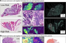 New AI tool predicts whether aggressive small cell lung cancer will respond to treatment