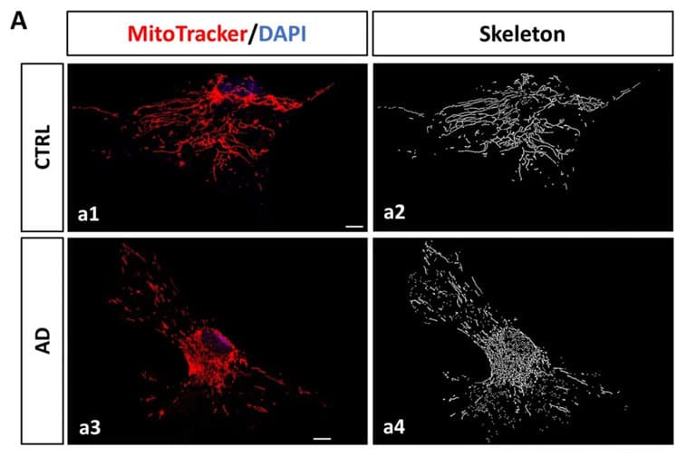 Senescent astrocytes discovered in Alzheimer's brains point to new treatment targets