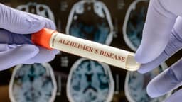 Drug Taken for Common Condition May Be Slowing Alzheimer’s Decline