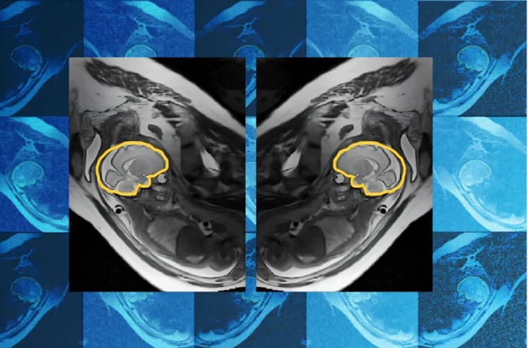 AI Tool Improves Fetal MRI for Brain Abnormality Diagnosis