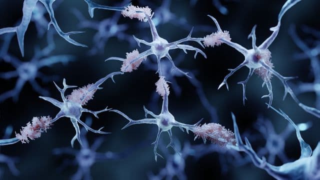 Not All Amyloid Plaques Are the Same in Alzheimer’s Disease